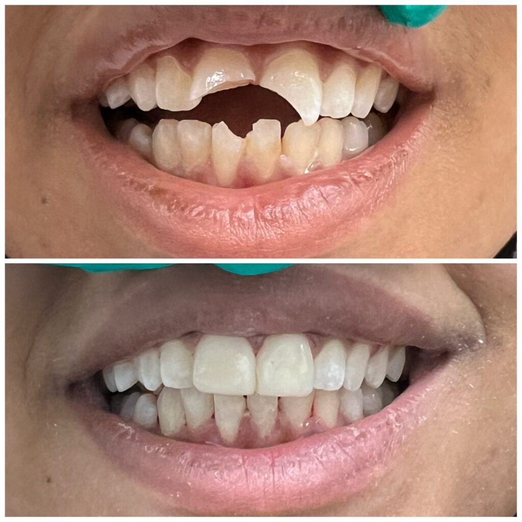 before and after of chipped tooth repair