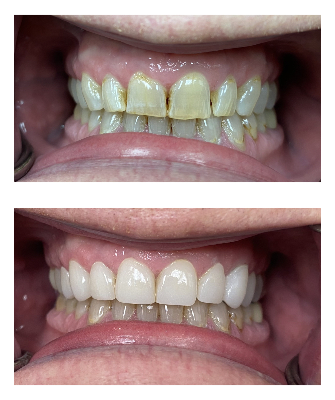 Before and after of teeth