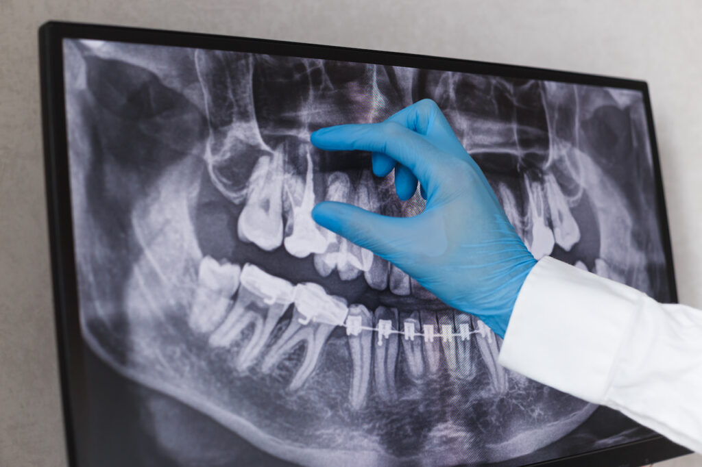 root canal specialist pointing to root canal on xray